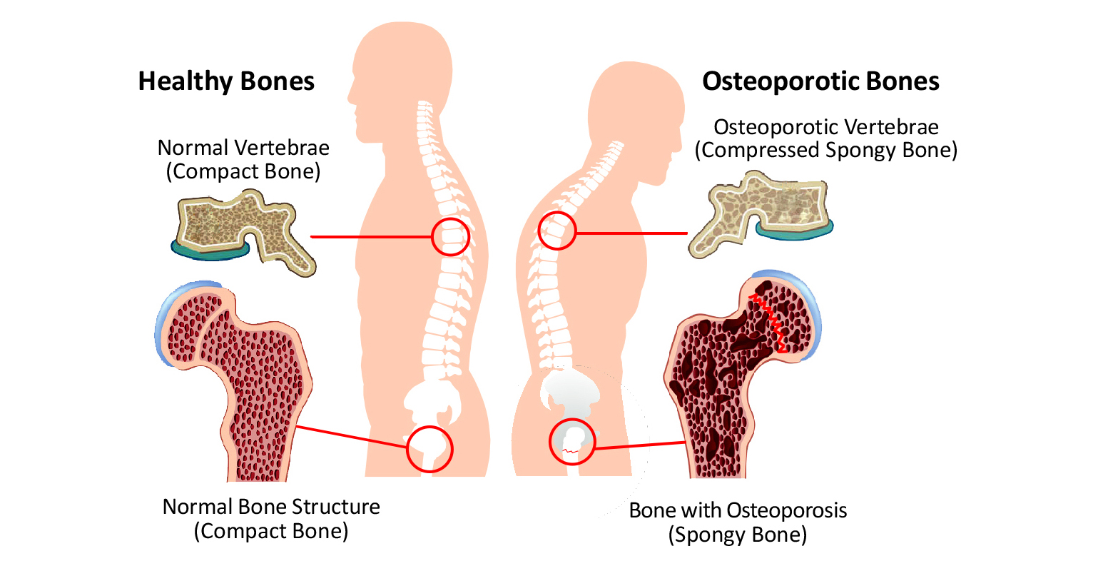 Que significa osteopenia