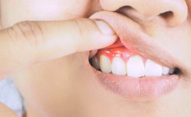 Kanceri: Problemi ‘i zakonshëm’ i gojës mund të jetë duke rritur rrezikun e sëmundjes vdekjeprurëse