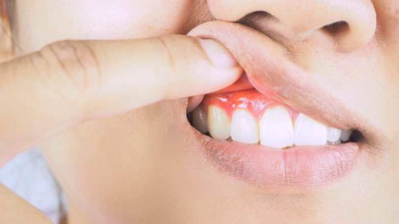 Kanceri: Problemi ‘i zakonshëm’ i gojës mund të jetë duke rritur rrezikun e sëmundjes vdekjeprurëse