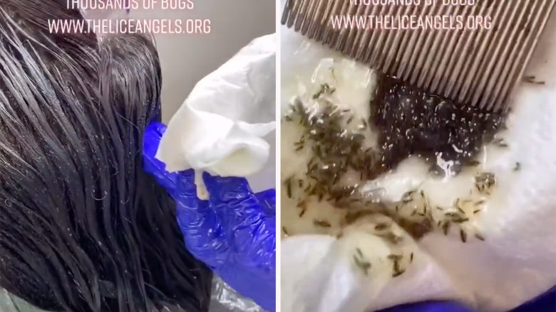 Eksperti i flokëve të shëndosha shpërndanë video rrëqethëse – nga koka e një vajze të re nxjerr mijëra morra