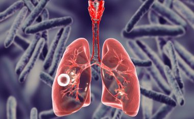 Simptomat dhe shkaqet e tuberkulozit, siç paralajmëron mjekja, kolla e vazhdueshme mund të mos jetë COVID-19