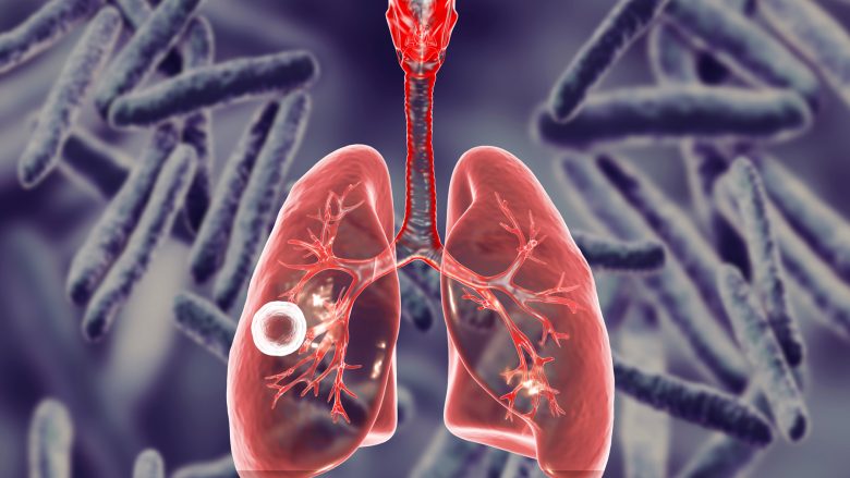 Simptomat dhe shkaqet e tuberkulozit, siç paralajmëron mjekja, kolla e vazhdueshme mund të mos jetë COVID-19
