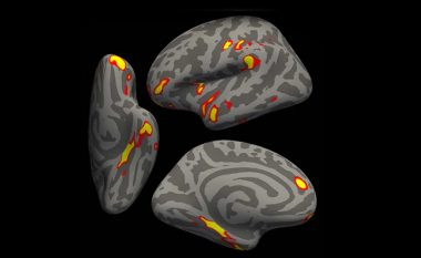 Studimi i ri: Të prekurit me COVID-19, mund të kenë përshpejtuar plakjen e trurit dhe ndryshime të tjera në të