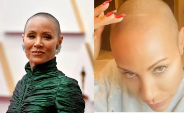 Çfarë është alopecia areata, çrregullimi auto-imun nga i cili vuan Jada Pinkett Smith?