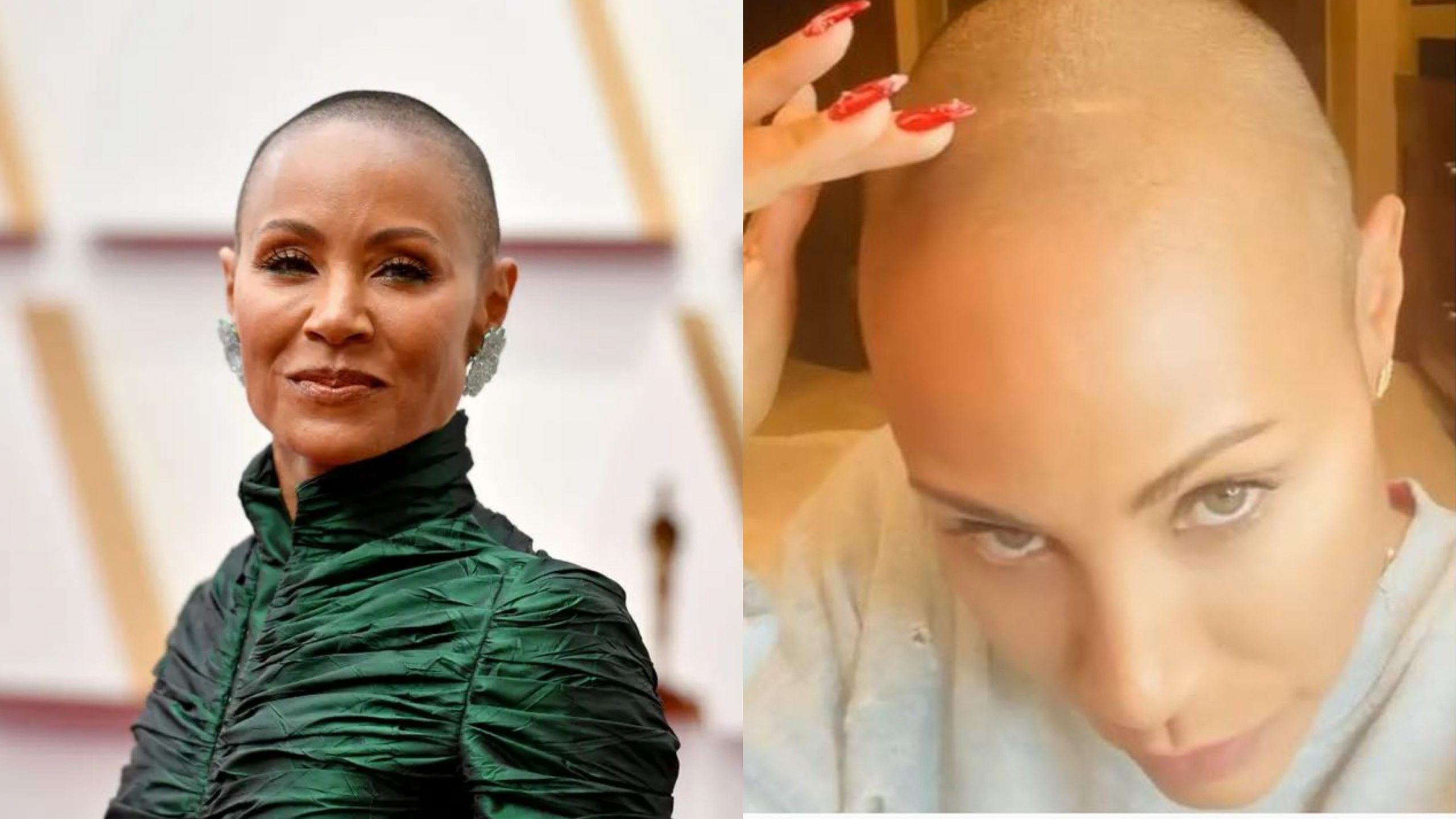 Çfarë është alopecia areata, çrregullimi auto-imun nga i cili vuan Jada Pinkett Smith?