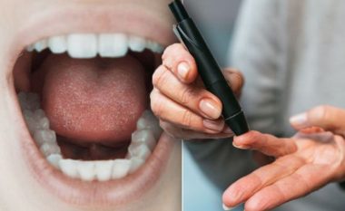 Simptomat e diabetit në gojë që nuk duhet t’i injoroni kurrë