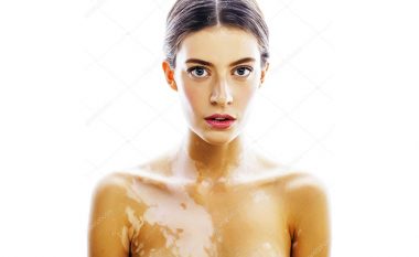 Vitiligo – një sëmundje e lëkurës që shkakton humbje të pigmentit