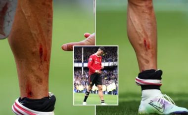 Cristiano Ronaldo tregon këmbën e gjakosur pas përfundimit të ndeshjes ndaj Evertonit, zbulon shenjën e tmerrshme