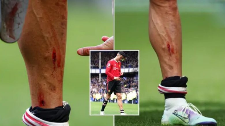 Cristiano Ronaldo tregon këmbën e gjakosur pas përfundimit të ndeshjes ndaj Evertonit, zbulon shenjën e tmerrshme