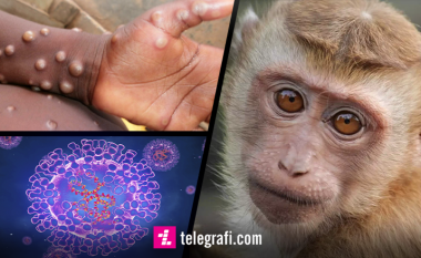 ‘Lia e Majmunëve’, flet infektologu Ramadani: Të prekurit nga kjo sëmundje rekomandohet të izolohen për 10 ditë
