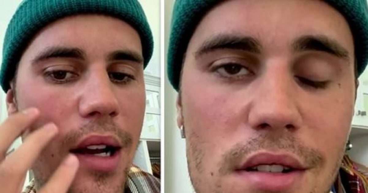 Justin Bieber Reveals He Is Suffering From Facial Paralysis After Being Diagnosed With Ramsay