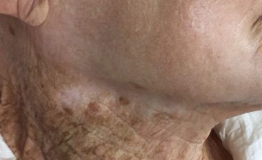 Dyzet vjet ka lyer fytyrën me krem për rrezitje, por jo edhe qafën: Shikoni ndikimin e diellit prej më shumë se dy deceniesh