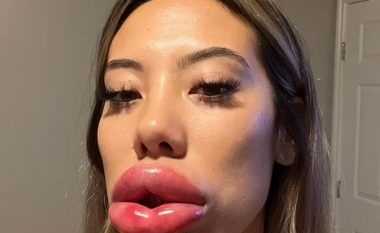 Buzët e amerikanes u frynë trefish pas një reaksioni alergjik kur bëri ndërhyrje