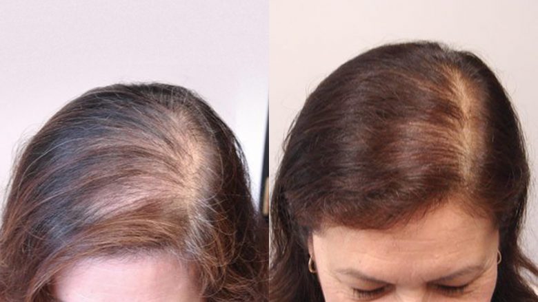 Me rezultat 100% pas 10 larjeve të para, ky shampon me rozmarinë parandalon rënien e flokëve!