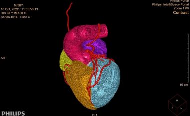 Rivaskularizimi i plotë i arterieve tek sëmundjet koronare të zemrës