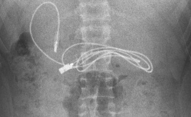 Kishte dhimbje dhe të përziera – djaloshit i gjendet një kabllo 90 centimetra e gjatë brenda stomakut