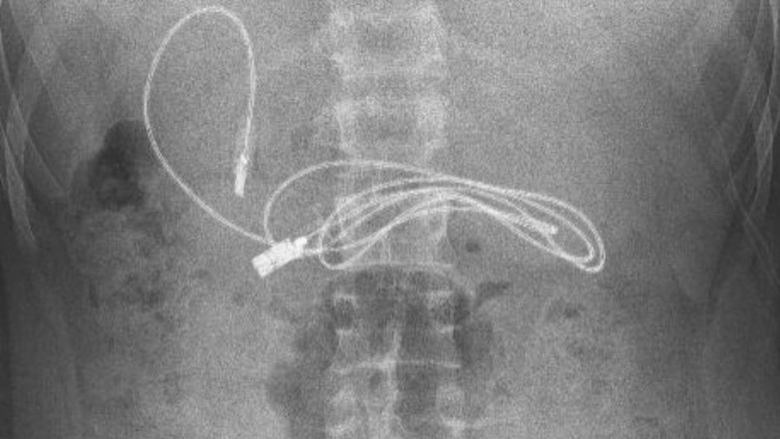 Kishte dhimbje dhe të përziera – djaloshit i gjendet një kabllo 90 centimetra e gjatë brenda stomakut