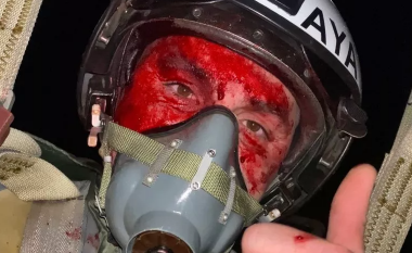 Piloti luftarak ukrainas pozoi me fytyrë të gjakosur pas një beteje për rrëzimin e dronëve iranianë - rrëfen se si ndodhi kur u detyrua të hidhej nga aeroplani i tij