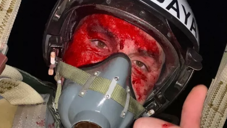 Piloti luftarak ukrainas pozoi me fytyrë të gjakosur pas një beteje për rrëzimin e dronëve iranianë – rrëfen se si ndodhi kur u detyrua të hidhej nga aeroplani i tij