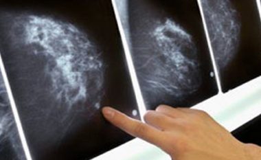 Terapi e re molekulare kundër kancerit të gjirit