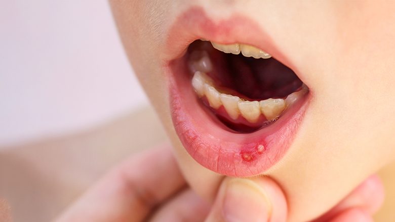 A ka fëmija plagë të bardha në gojë që dhembin? Bëhet fjalë për afta, ja si mund t’ua lehtësoni dhembjet
