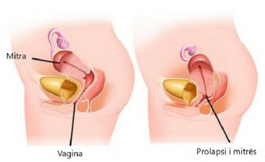 “Prolapsi i organeve gjenitale tek gratë” – për diagnostifikim dhe zgjidhje flet Prof. Dr. Vasil Iliev