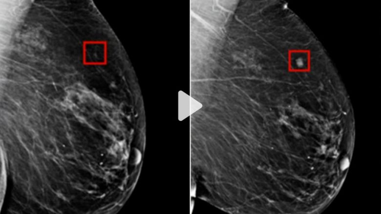 Imazhet tregojnë sesi inteligjenca artificiale ka detektuar kancerin e gjirit katër vite para se të zhvillohej