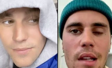 U diagnostikua me sindromën ‘Ramsay Hunt’ – Justin Bieber zbulon për fansat procesin e shërimit nga sëmundja