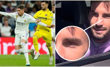Alex Baena shihet me shenjë në sy pesë ditë pasi u sulmua nga Fede Valverde