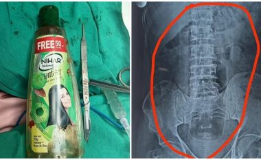 Shkoi me dhimbje të mëdha barku, mjekët në Indi i nxjerrin burrit nga barku shishen e plastikës të shamponit