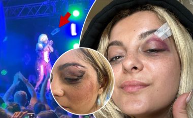 Bebe Rexha reagon pas sulmit të fansit në koncert duke publikuar fotografitë e qepjes në fytyrë: Jam mirë