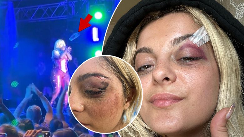 Bebe Rexha reagon pas sulmit të fansit në koncert duke publikuar fotografitë e qepjes në fytyrë: Jam mirë