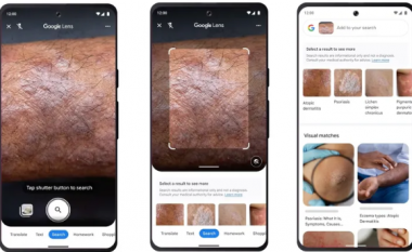 Google thotë se aplikacioni Lens mund të ndihmojë në identifikimin e problemeve të lëkurës