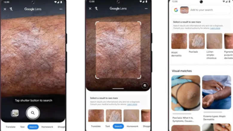 Google thotë se aplikacioni Lens mund të ndihmojë në identifikimin e problemeve të lëkurës