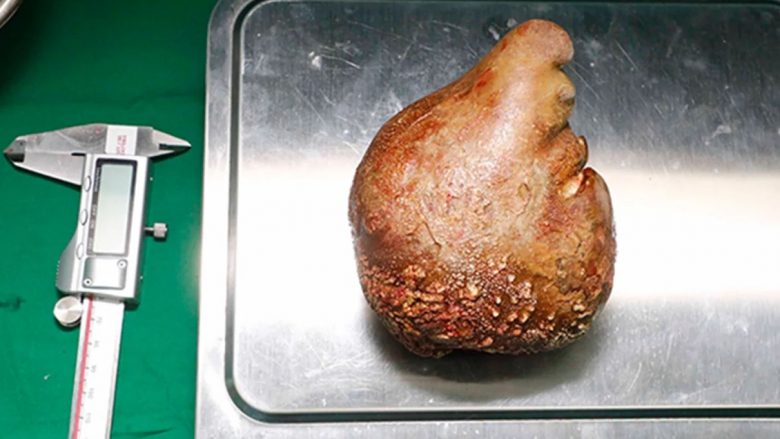Guri më i madh në veshka në botë i është hequr një pacienti në Sri Lanka