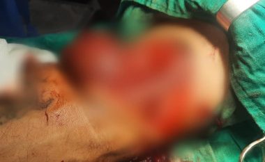 Operacion shumë i rrallë e i ndjeshëm në QKUK, i shpëtohet krahu pacientit që pothuajse e kishte të amputuar