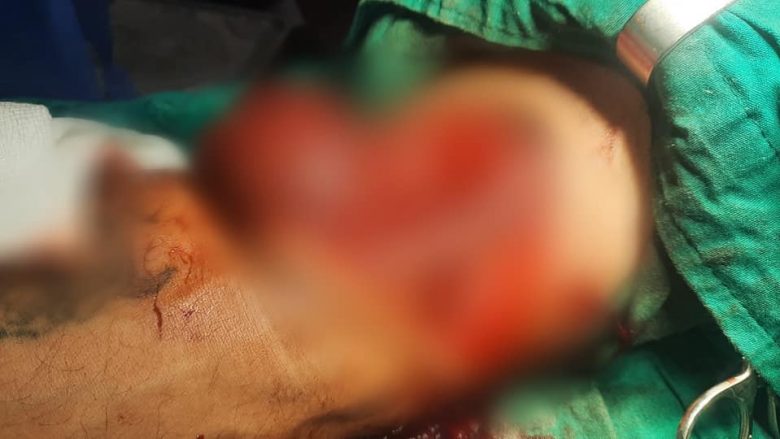 Operacion shumë i rrallë e i ndjeshëm në QKUK, i shpëtohet krahu pacientit që pothuajse e kishte të amputuar