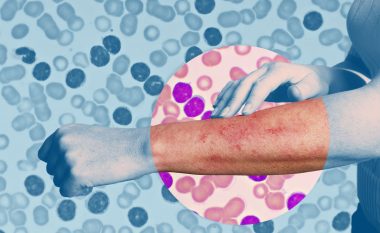 Tri simptomat paralajmëruese të leukemisë që nuk duhet t’i injoroni kurrë