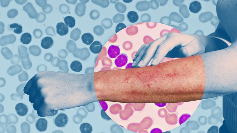 Tri simptomat paralajmëruese të leukemisë që nuk duhet t’i injoroni kurrë