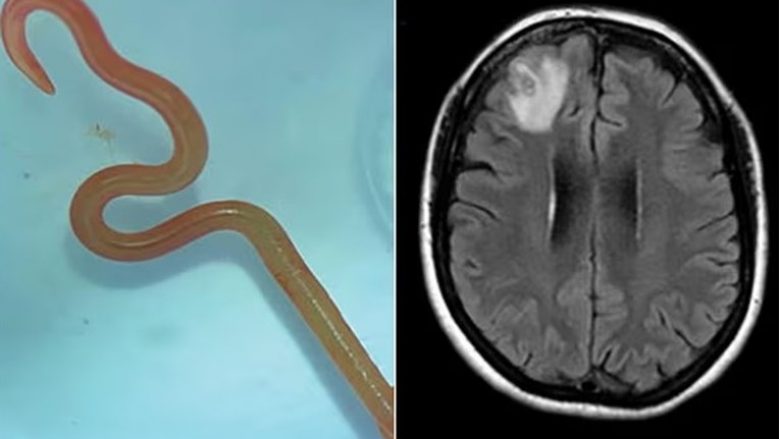 “Është i gjallë dhe po lëvizë” – kirurgët hoqën nga truri i një gruaje në Australi krimbin e gjallë tetë centimetra të gjatë