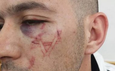 Policia izraelite mohon të ketë ‘gdhendur’ Yllin e Davidit në fytyrën e një palestinezi – ekspertët e mjekësisë ligjore japin mendimin e tyre