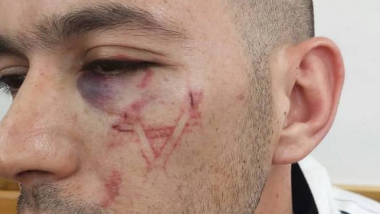 Policia izraelite mohon të ketë ‘gdhendur’ Yllin e Davidit në fytyrën e një palestinezi – ekspertët e mjekësisë ligjore japin mendimin e tyre