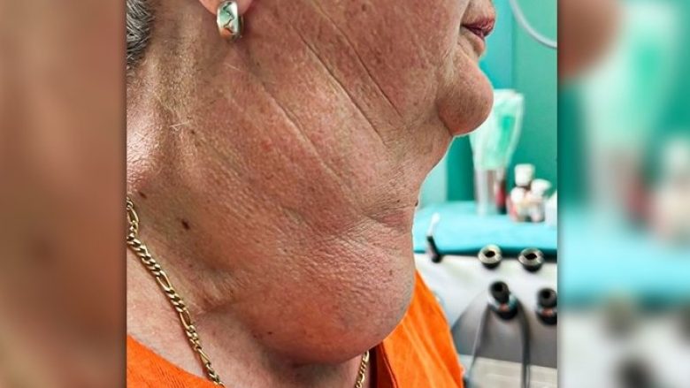 Mjekët kroatë i hoqën gruas 73-vjeçare një tiroid gati dy kilogramë