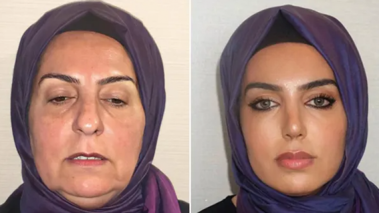 A është i njëjti person? – Njerëzit nuk mund ta besojnë ndryshimin e madh pas ndërhyrjeve që bëri kjo grua në një klinikë në Turqi