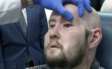Transplanti i parë i suksesshëm i syrit në botë, amerikanit iu zëvendësua edhe gjysma e fytyrës