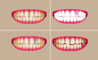 Çfarë mund të zbulojë ngjyra e dhëmbëve për shëndetin tuaj – dhe kur duhet të shqetësoheni?