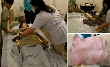 Mjekësia alternative për pak sa nuk i kushtoi me jetë tajlandezes, ia lyen barkun me vaj dhe u përfshi nga zjarri – pësoi djegie të shkallës së tretë