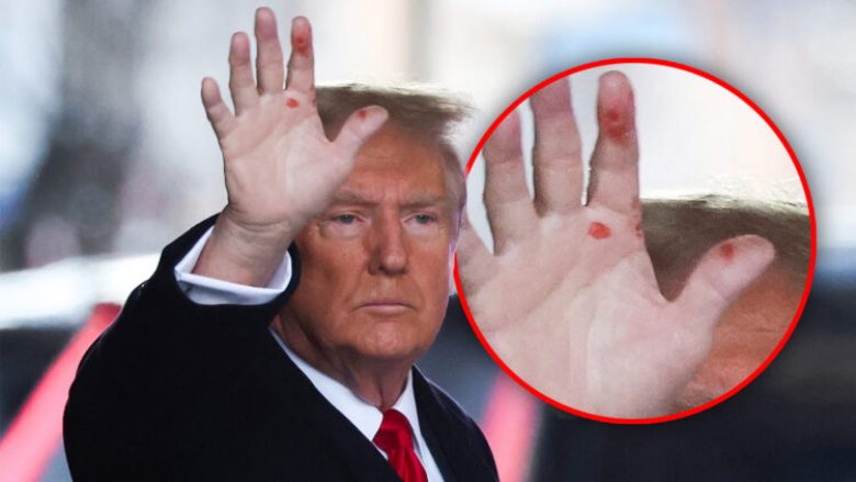 Çfarë po ndodh me Trumpin? Ish-presidenti amerikan është fotografuar me “njollë të çuditshme në duar”