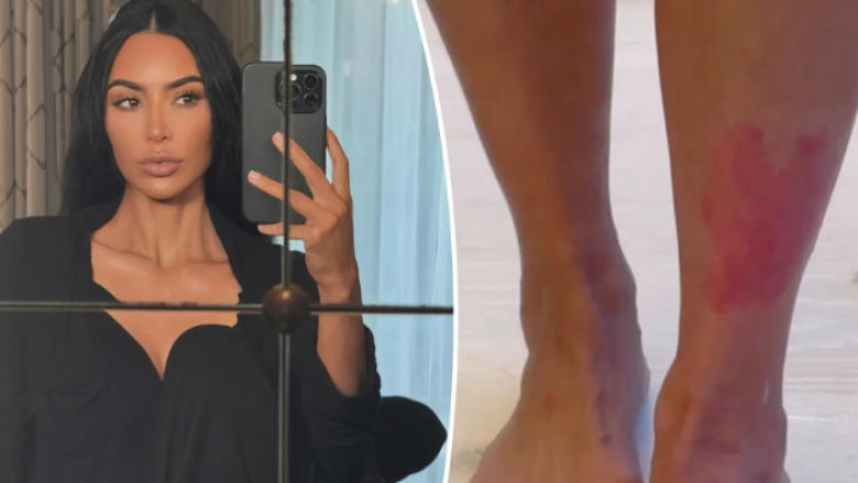 Kim Kardashian tregon realitetin e dhimbshëm të ‘shpërthimit’ të psoriazës: Nuk e di se çfarë po ndodh