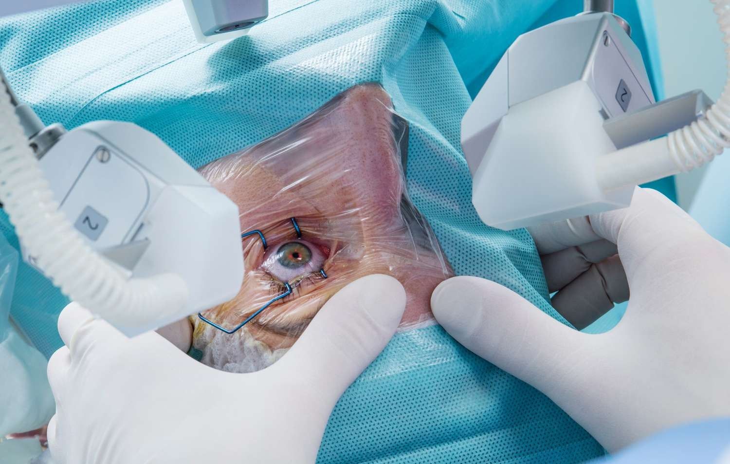 What cataract surgery looks like Everything you wanted to know about